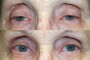 Before and after image of a 81-year-old patient who underwent ptosis and blepharoplasty surgery, showing the differences in eyelid appearance.