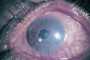 Image showing ocular rosacea with embedded text