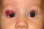 Image showing results 1 month after treatment started