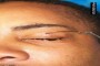 Fishhook in the eyelid