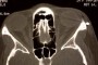 X-ray image showing a BB pellet in the lateral orbit area of the skull