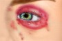 Peri-ocular herpes simplex