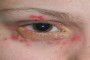 Peri-ocular herpes simplex