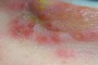 Image showing peri-ocular herpes simplex