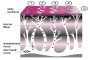 Diagram showing the course of shingles with labeled stages and descriptions