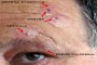 A clinical photo showing a close-up of a skin condition with red and inflamed areas. The embedded text reads Patient A, Day 5 of Treatment