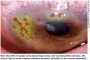Image depicting corneal involvement, showing signs of corneal damage and inflammation, with the text 'corneal involvement' embedded in the image