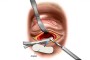 Implant positioned over the hole (fracture)