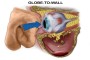 Illustration depicting the Globe-to-Wall Theory of Orbital Floor Fracture.