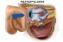 Image showing the Retropulsion Theory of Orbital Floor Fracture