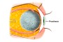 Anophthalmos | implant | scleral shell