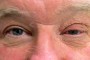 Image showing Left Ptosis, lash ptosis, and floppy eyelid