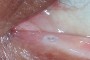 Image showing a plug inserted into the lower eyelid for dry eye treatment.