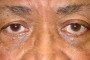 A person's face with bandages over the left eye. Text overlay reads: 'After surgery, left eye has receeded'