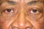 Photograph showing left proptosis and lower eyelid retraction.