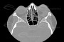 Axial CT scan showing a left orbital hemangioma