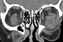 Coronal CT image showing a left orbital hemangioma.
