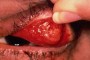 Left upper eyelid Sebaceous Cell Carcinoma