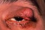 Image of a left upper eyelid mass that looks similar to a chalazion.