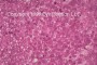 Histology of Sebaceous Cell Carcinoma, showing sebaceous cells
