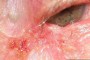 Image showing Sebaceous Cell Carcinoma in the medial canthal area