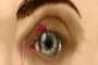 Floppy eyelid syndrome surgery repair