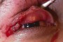 Photograph showing a medical condition of the lateral right upper lid margin avulsion