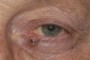 A photograph depicting a tumor in the eye with a caption that reads 'p-eye_tumour-3'