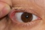 Image showing laxity in the upper eyelid