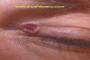 A basal cell carcinoma (skin cancer) shown in a medical illustration.