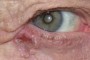 A basal cell image showing the characteristics of basal cell carcinoma.
