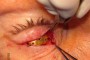 Gold Weight sutured to tarsus