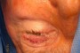 Image showing a closed skin incision