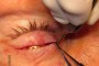 Skin incision about to be closed