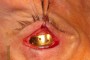 Gold Weight in position on the surface of the tarsus