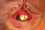 Gold Weight sutured to tarsus