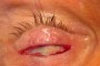 Image showing an eyelid incision being made, with the tarsus visible.