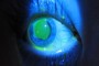 Corneal abrasion highlighted with a stain