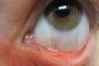 Punctal Plug in lower and upper puncti