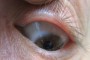 Photograph of a punctal plug inserted into the upper puncti. The image has an opacity of 0.7.