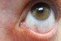 Image showing a punctal plug inserted into both the lower and upper puncti.