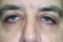 An image showing lash ptosis with embedded text