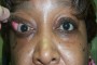 Image of ity Upper Eyelid