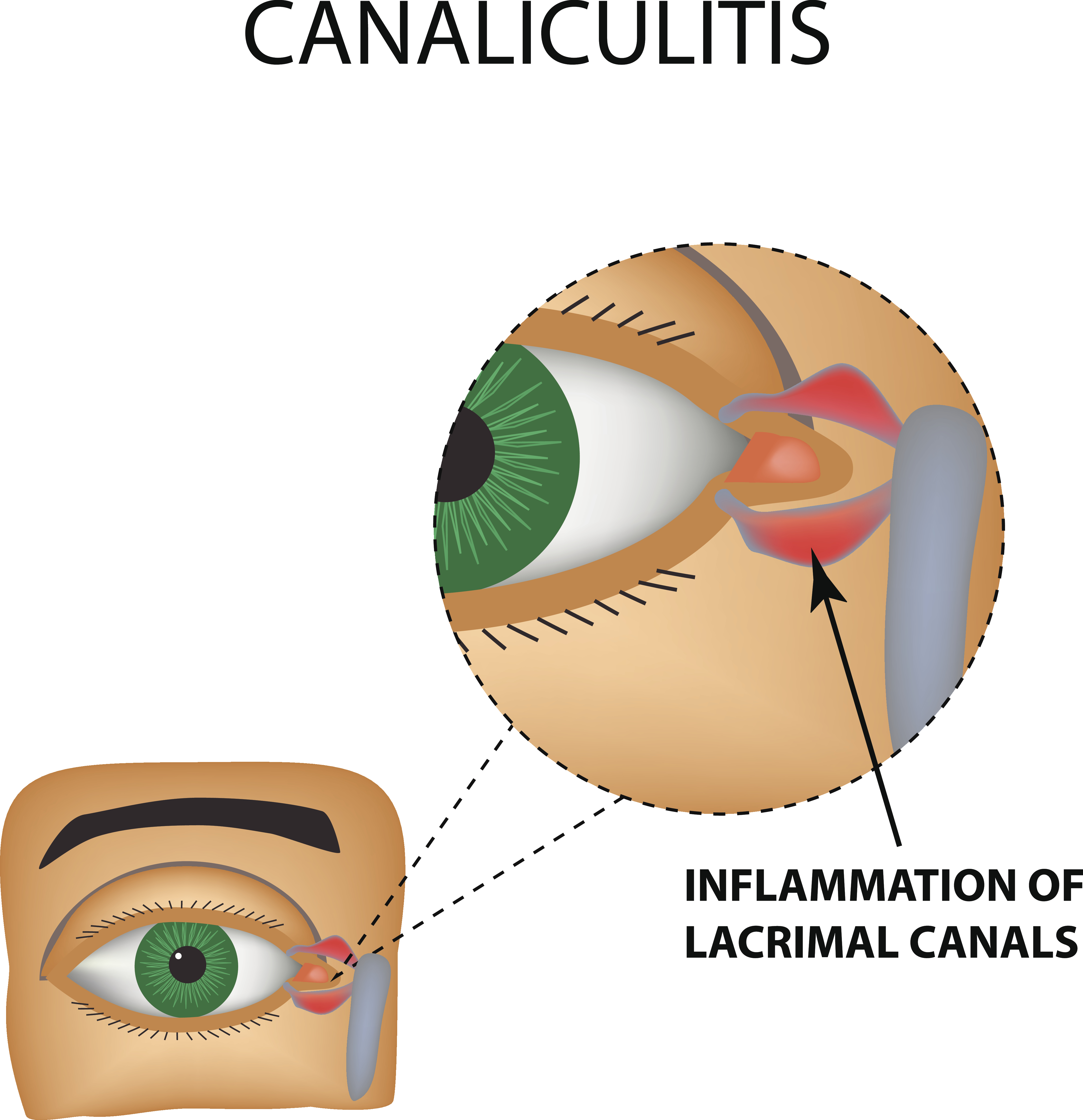 Canaliculitis