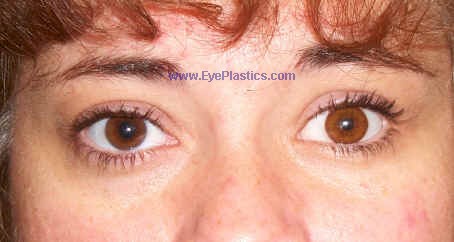 Enhance Prosthetic Eye Motility with