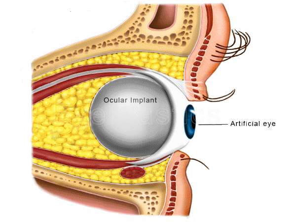 Artificial eye illustration, showing detailed components and labeling