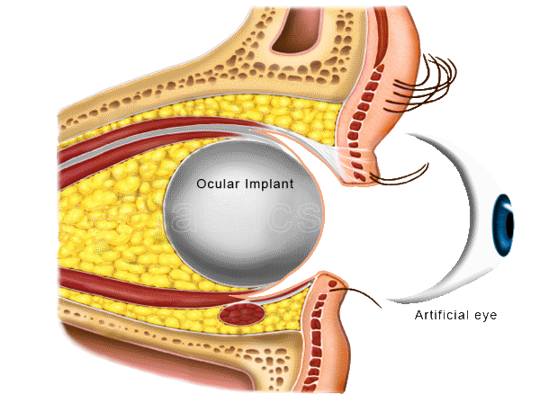 Artificial eye illustration