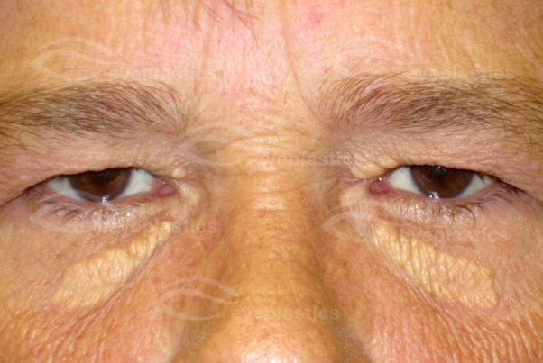 Xanthelasma on the eyelid of a person.