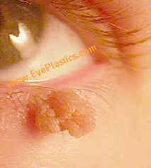 A medical illustration showing a papilloma, which is a small wart-like growth on the skin or mucous membrane. The image might include labels identifying different parts of the papilloma.