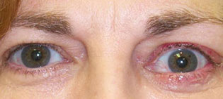 Pre and Post Operative Photographs for patient P00016881
